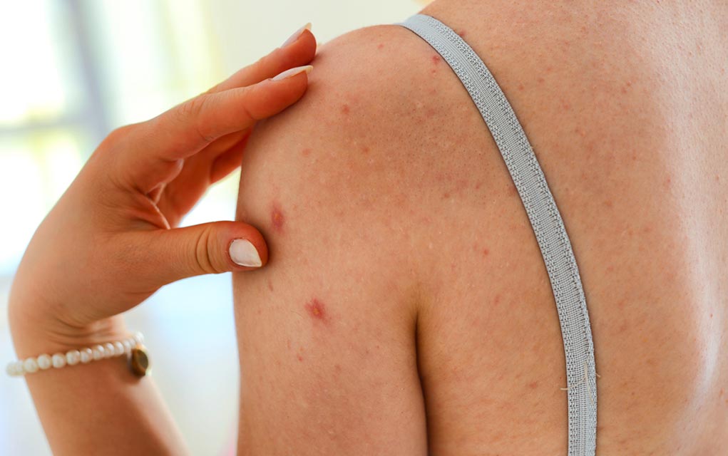 would-you-recognize-the-early-symptoms-of-shingles