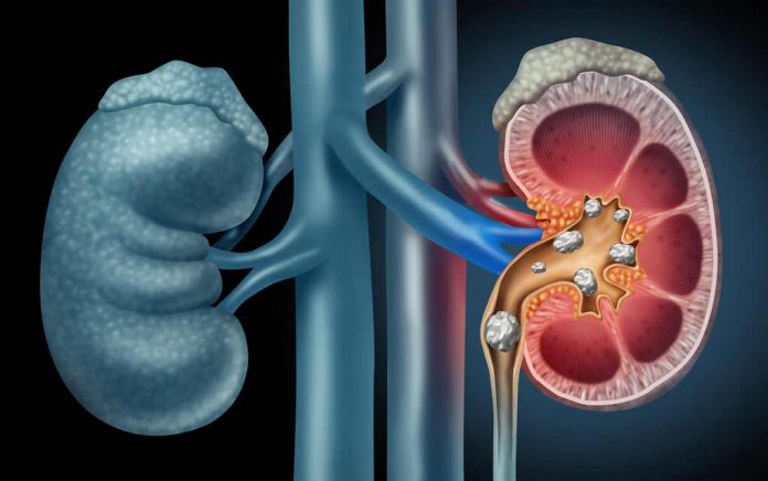 Why-You-May-Be-More-Prone-to-Kidney-Stones
