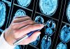 5 Startling Facts About Epilepsy