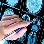 5 Startling Facts About Epilepsy