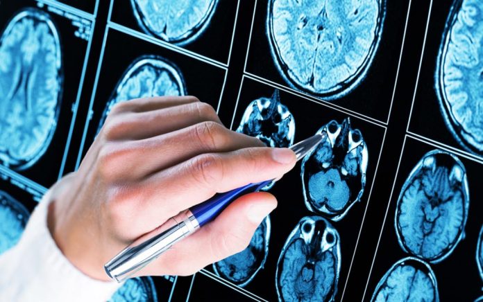 5 Startling Facts About Epilepsy