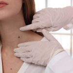 How to Safely Get Rid of Skin Tags