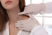How to Safely Get Rid of Skin Tags