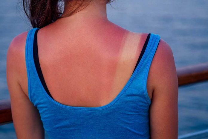 Burnt,Female,Skin,In,The,Sun,Close-up,In,A,Blue Try THESE Natural Remedies for Sunburn