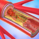 5 Signs Your Arteries are Clogged (and What To Do)