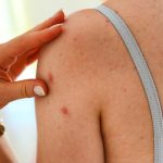 Would You Recognize the Early Symptoms of Shingles?