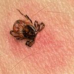 Lyme Disease: Chronic Symptoms or Post-Treatment Syndrome?