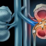 Why You May Be More Prone to Kidney Stones