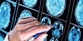 5 Startling Facts About Epilepsy