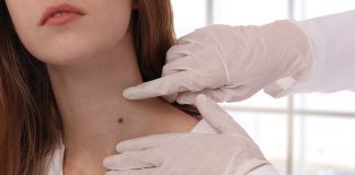 How to Safely Get Rid of Skin Tags