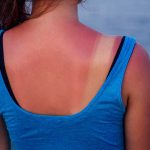 Try THESE Natural Remedies for Sunburn Try THESE Natural Remedies for Sunburn