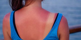 Try THESE Natural Remedies for Sunburn